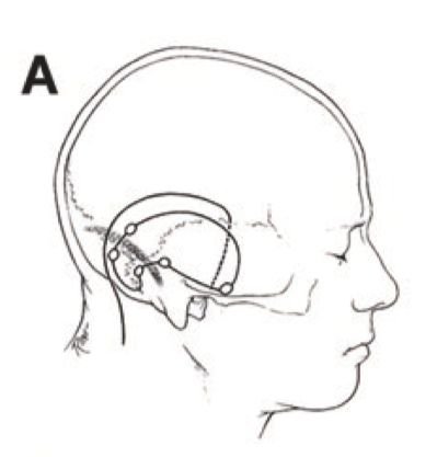圖A: 采用幕上-幕下聯(lián)合入路，顳枕聯(lián)合皮瓣，在顳部行低位顳部骨瓣開(kāi)顱。