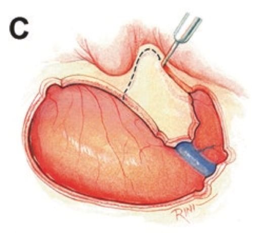 圖C：切除在顳枕區(qū)域至枕下區(qū)域延伸的L形骨瓣后，沿著乳突周?chē)鈱娱_(kāi)始逐步完成乳突切除術(shù)。骨瓣大小取決于聽(tīng)力狀況和基礎(chǔ)暴露的需要。