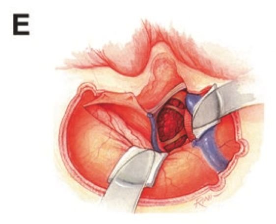 圖E: 打開(kāi)硬膜，避免損傷橫-乙狀竇及Labbé靜脈，該區(qū)域后顳葉的靜脈引流存在變化(有時(shí)是多種多樣的)，結(jié)扎上巖竇后，并確保顳葉的引流通暢，沿著巖骨尖分離天幕，定位并注意保護(hù)滑車(chē)神經(jīng)等。