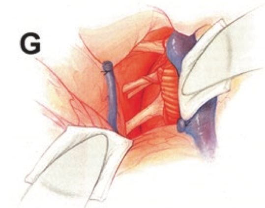 圖G：腫瘤成功全切，神經(jīng)組織保存完好。