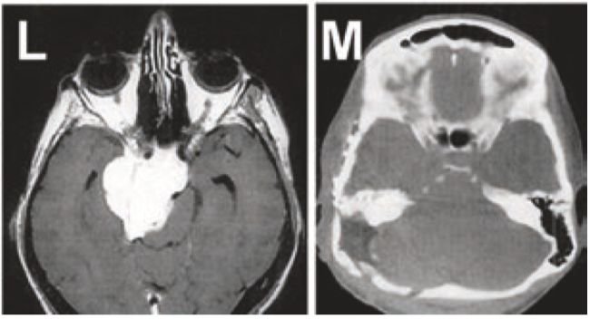 圖L+M：巖斜區(qū)腦膜瘤患者，術(shù)前術(shù)后的影像對(duì)比