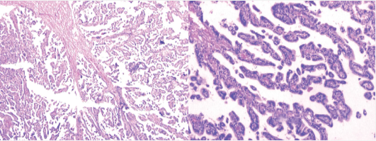 顯微照片顯示纖維血管核心的多個(gè)乳頭狀結(jié)構(gòu)（左）、乳頭狀結(jié)構(gòu)排列整齊的立方至柱狀上皮細(xì)胞（右）
