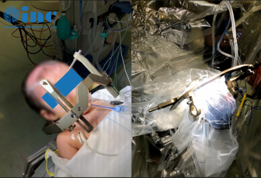 最終利利的腦瘤得到了極大程度的消融