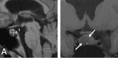 核磁共振成像顯示垂體窩中有一個(gè)小腫瘤，將正常垂體向左側(cè)移位