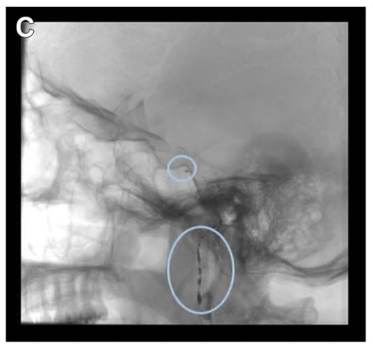諾亞術前栓塞咽升動脈及腦膜垂體干