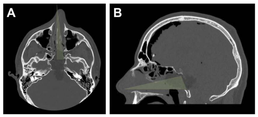 A、B：術后 CT 軸位及矢狀位，綠色顯示單鼻孔入路，鼻腔完整性得以保持;鼻中隔、上頜竇、后組篩竇及左側蝶竇間隔均完整。
