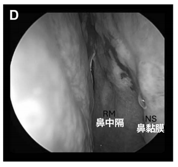 術后 4 周內鏡復查顯示鼻黏膜縫合處愈合良好，無結痂，患者無鼻部不適主訴。