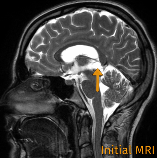 她的腦子里，松果體區(qū)長了一個囊腫。