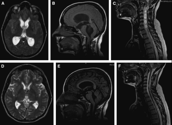 【INC國(guó)際大咖研究成果】?jī)?nèi)鏡下第三腦室造瘺術(shù)治療 Chiari I 畸形及相關(guān)腦積水：結(jié)果及發(fā)病機(jī)制意義