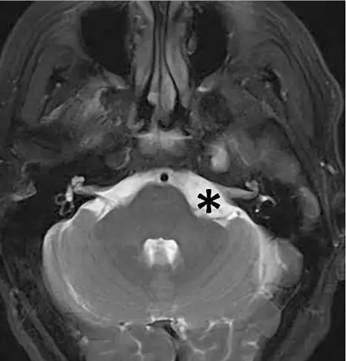 圖 1 *號(hào)所標(biāo)位置附近即為橋小腦角區(qū)，此處可見(jiàn)