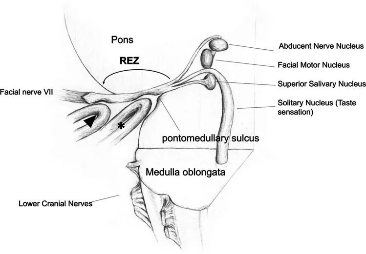 然而，不同患者在術(shù)后的改善模式及達(dá)到最終緩解所需時(shí)間差異顯著，且多種因素可能影響其恢復(fù)進(jìn)程。