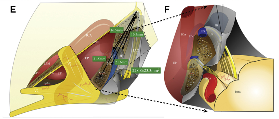 圖：經(jīng)巖骨菱形區(qū)后向視角展示頸靜脈孔內(nèi)側(cè)部解剖關(guān)系。