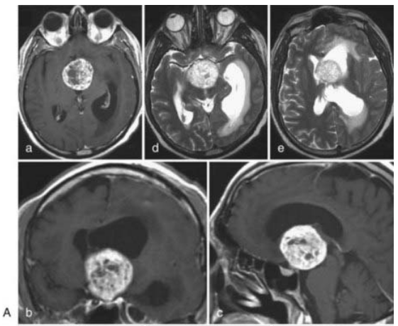 術(shù)前MRI顯示：第三腦室內(nèi)富血管腫瘤(顱咽管瘤)，壓迫并擴(kuò)張中腦被蓋，向上達(dá)室間孔水平(圖A)。