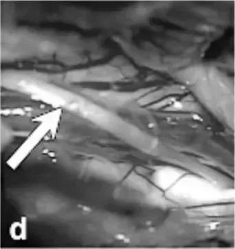 巴教授果斷采取經(jīng)右側(cè)顳下入路實施手術(shù);術(shù)中發(fā)現(xiàn)，在滑車神經(jīng)水平，被蓋表面明顯膨隆(箭頭，圖d)。