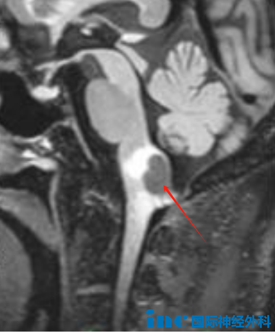 延髓背側(cè)占位性病變