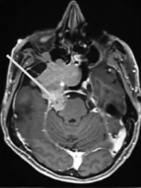 全方位切除腫瘤步驟