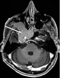 全方位切除腫瘤步驟
