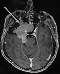 全方位切除腫瘤步驟