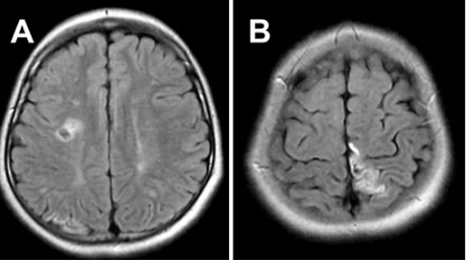患者初次就診時進行的 FLAIR MRI，顯示 MMD 引起的雙側(cè)腦梗死