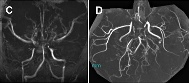 患者初次就診時進行的MRA