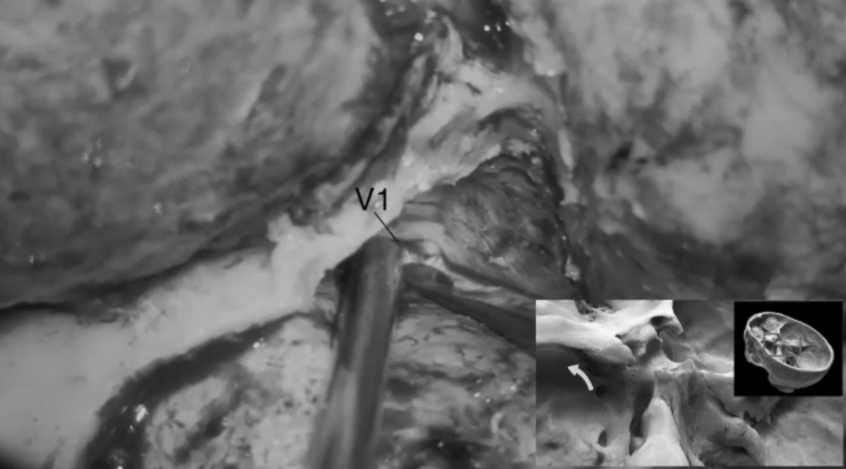 定位三叉神經(jīng)V1段，以助顯露眶上裂;游離并進(jìn)一步解剖眶上裂，識別、電凝并切斷眶腦膜韌帶。