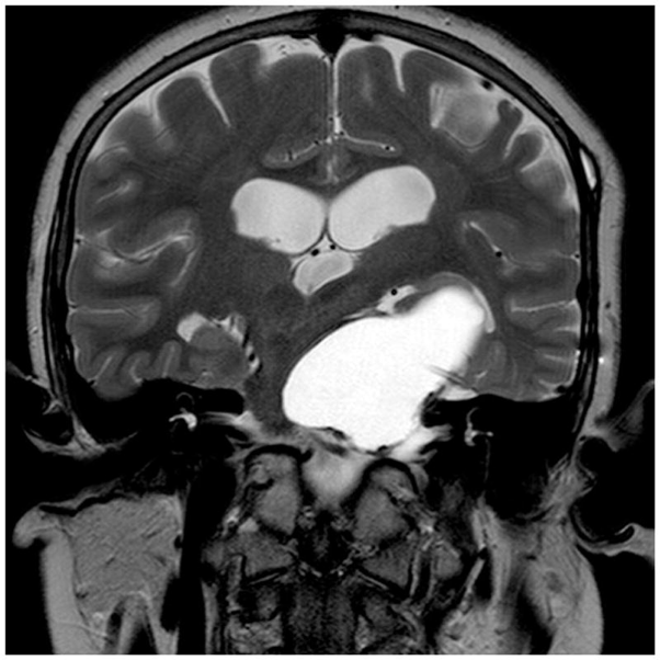 囊性顱咽管瘤用Ommaya儲液囊保守治療，上圖為置入Ommaya儲液囊之前