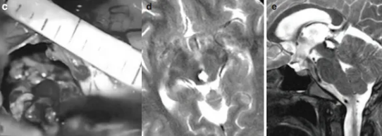 手術最終成功全切腦海綿狀血管瘤，術后喜喜的恢復情況令人欣慰，沒有出現(xiàn)任何術后并發(fā)癥，在樂觀的家庭氛圍感染下，當初那個愛笑的女孩又回來了！