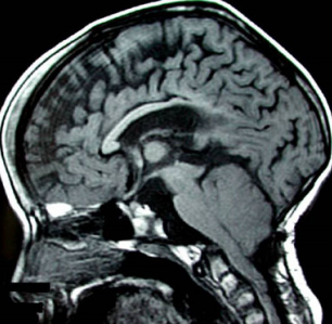 圖2 矢狀位 T1 加權(quán)腦像顯示腦脊液循環(huán)的主要阻塞部位：導(dǎo)水管狹窄及第四腦室腦室層面的消失;橋前池囊性擴(kuò)張;后顱窩結(jié)構(gòu)擁擠;蛛網(wǎng)膜下腔層面枕骨大孔阻塞。