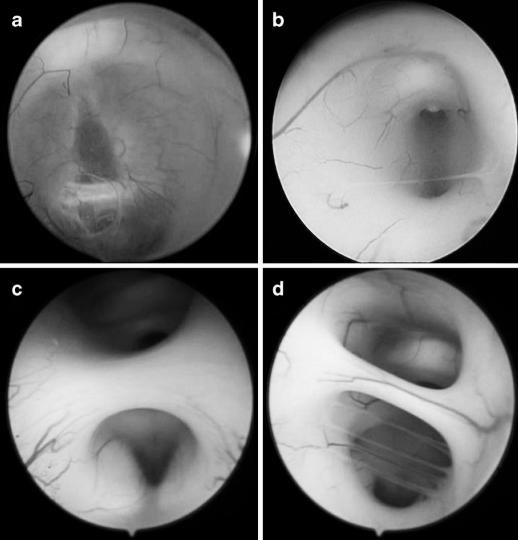 圖5 內(nèi)鏡下第三腦室底的不同表現(xiàn)，導(dǎo)致實(shí)施 ETV（內(nèi)鏡第三腦室造瘺術(shù)）難度遞增：a 呈水平狀、半透明且菲薄，可清晰辨認(rèn)漏斗隱窩；b 呈實(shí)質(zhì)樣，伴細(xì)薄下丘腦粘連；c 呈實(shí)質(zhì)樣，伴肥厚下丘腦粘連；d 呈實(shí)質(zhì)樣，伴肥厚下丘腦粘連及多條血管。