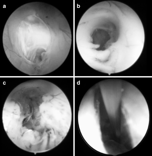 圖6　第三腦室底造瘺后的內(nèi)鏡解剖所見。a　多層膜結(jié)構(gòu);b　實(shí)質(zhì)樣腦室底下方為通暢的腦池間隙;c　實(shí)質(zhì)樣腦室底下方存在多條蛛網(wǎng)膜粘連帶;d　腦池深處僅見單一蛛網(wǎng)膜膜片，與實(shí)質(zhì)樣腦室底距離極遠(yuǎn)。