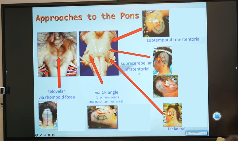 巴教授根據(jù)橋腦的解剖及病變的復雜關系總結了五大手術入路，包括：經髓帆入路、經橋腦臂入路、遠外側入路、小腦上外側入路、顳下經天幕入路。
