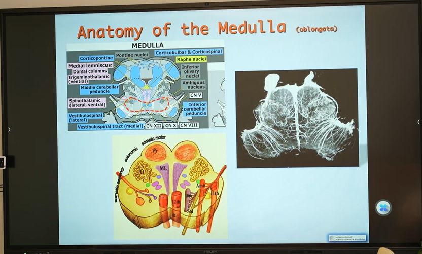 延髓海綿狀血管瘤