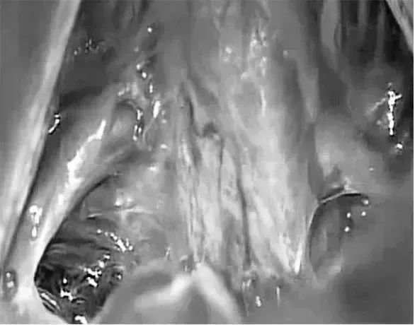 術(shù)中照片顯示Galenic靜脈引流通過小腦上蚓，小腦左側(cè)旁入路暴露的路線