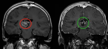 6年無復(fù)發(fā)