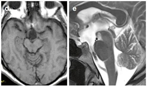 術(shù)后MRI證實(shí)腫瘤已肉眼全切