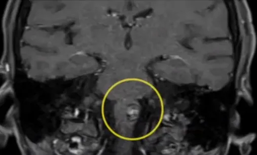 延髓海綿狀血管瘤