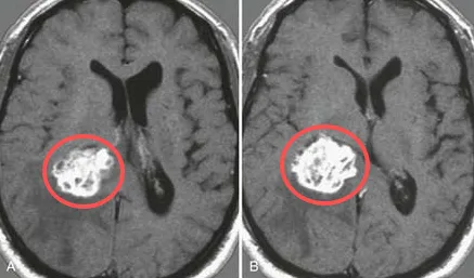 A與B：術(shù)前軸位增強T1加權(quán)MRI