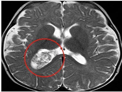 脈絡(luò)叢乳頭狀瘤
