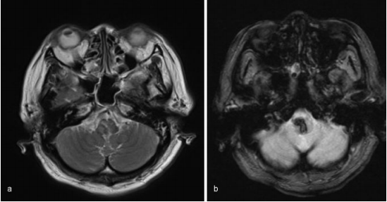 圖：磁共振圖像顯示出血沒有明顯的病理原因，（a）T2加權(quán)（b）T2加權(quán)。