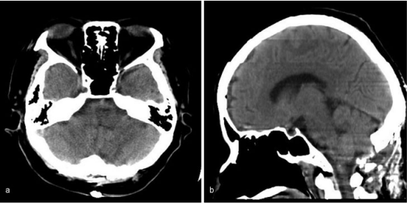 圖：術(shù)后電腦斷層掃描顯示延髓血腫消失