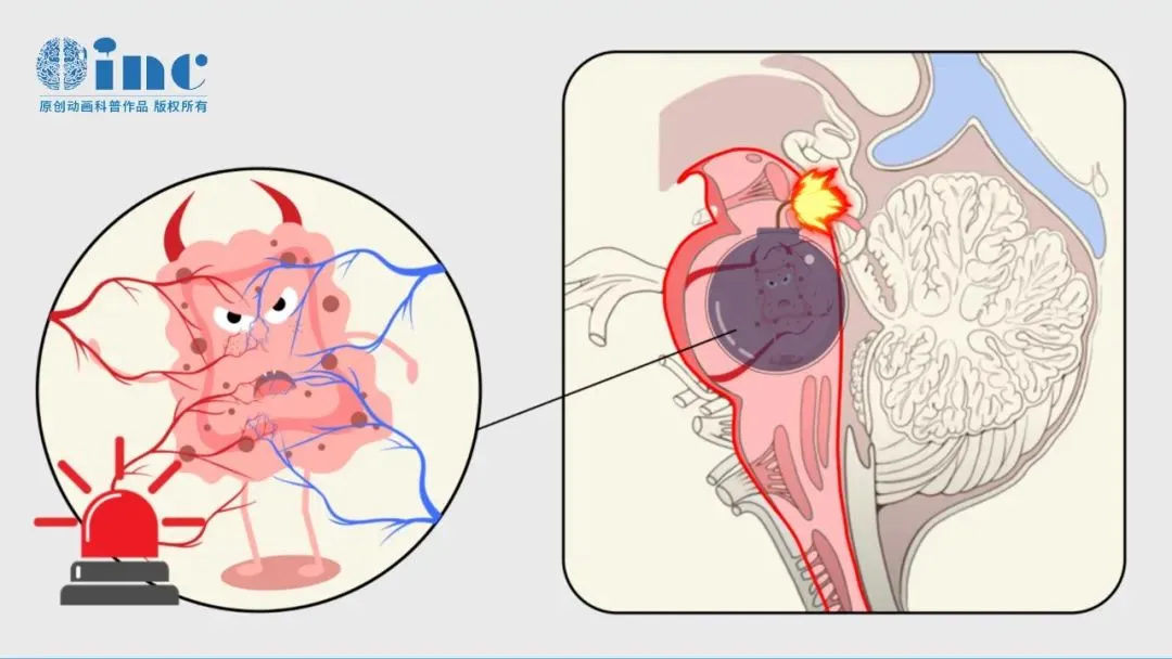 兒童腦海綿狀血管瘤