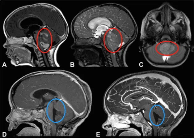第四腦室室管膜瘤