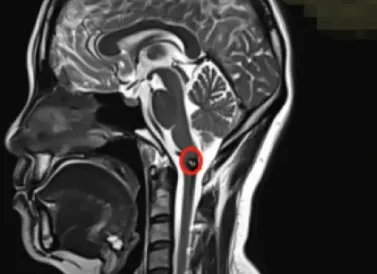 腦干-延髓海綿狀血管瘤影像