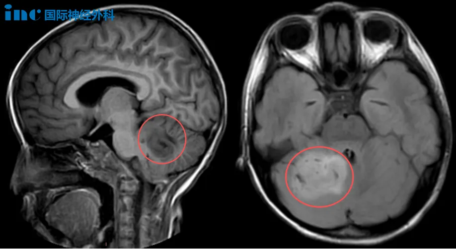 6歲女兒小腦巨瘤  　　和巴爺爺面對面交流后，我們決定手術！