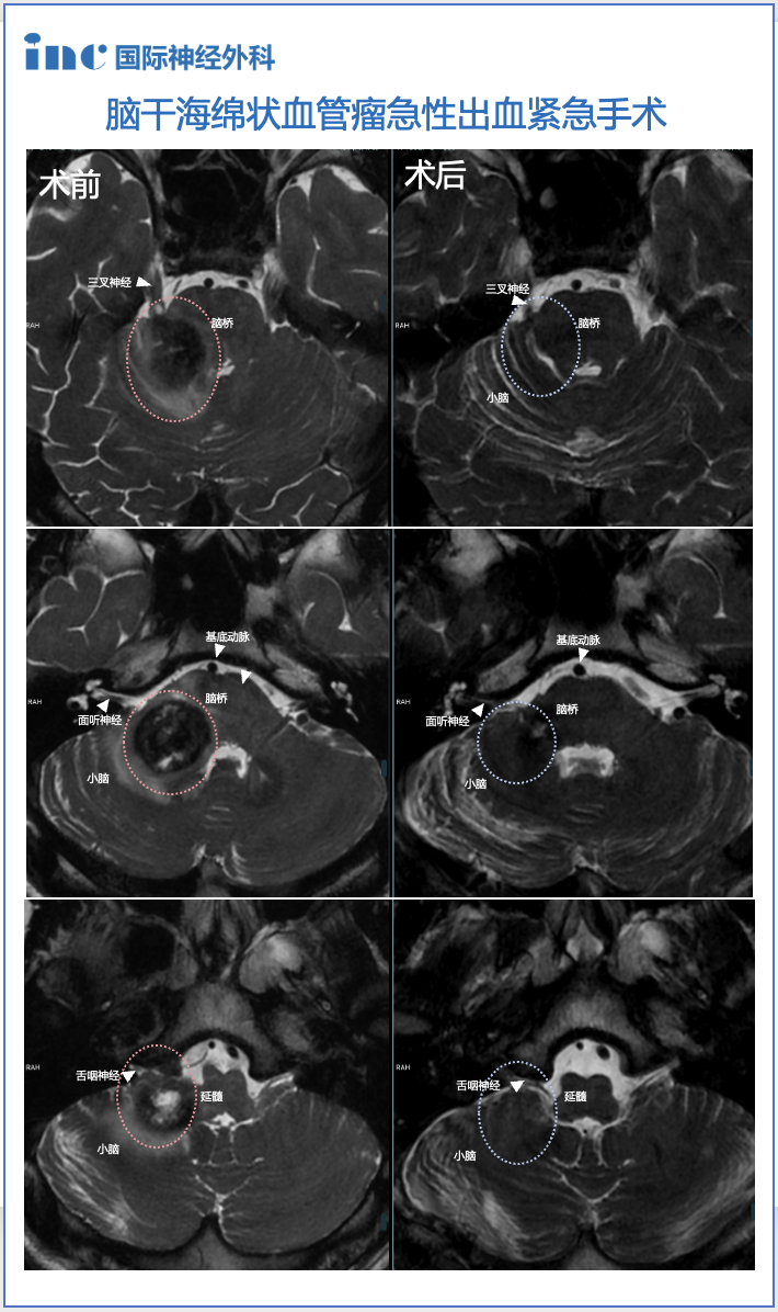 18歲橋臂海綿狀血管瘤