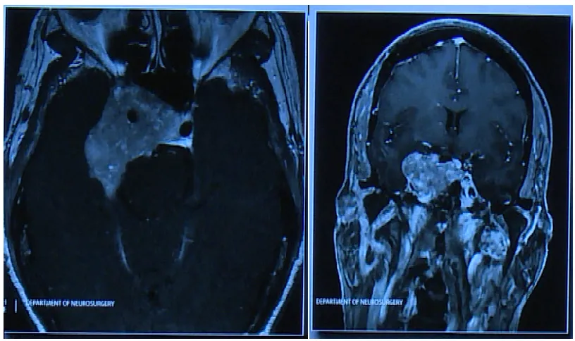 一位62歲女性患者，與垂體瘤抗?fàn)庨L達(dá)35年，曾因垂體瘤復(fù)發(fā)接受放射治療