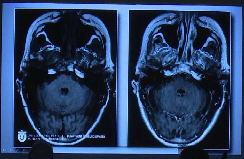 進(jìn)行開顱手術(shù)，術(shù)后影像片子顯示腫瘤切除干凈。
