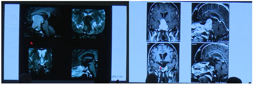 Couldwell教授演講中展示的部分巨大垂體瘤