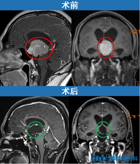 巨大垂體瘤一定要開顱嗎？