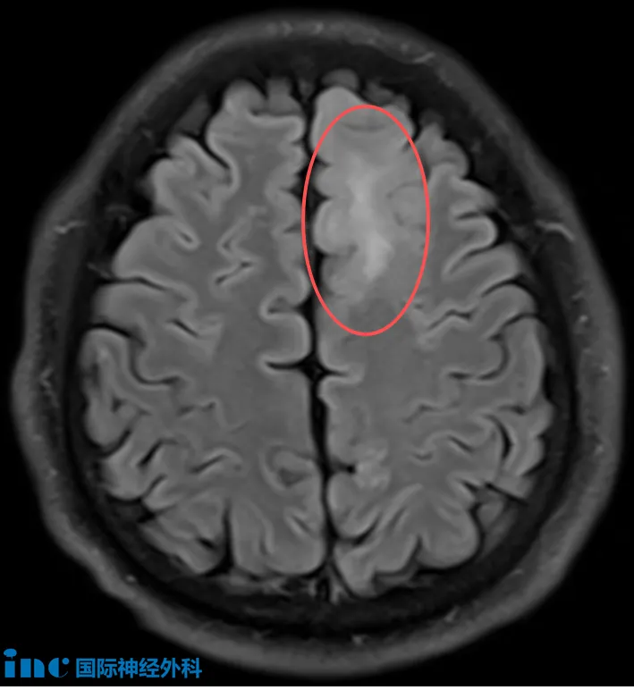 體檢驚現(xiàn)腦部病變